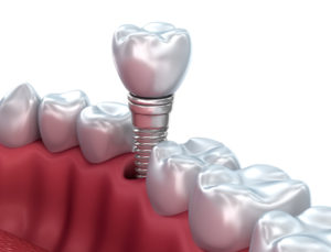 dental implants Southlake