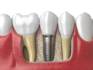 dental implants Southlake