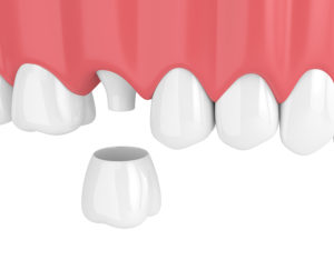 dental crowns Southlake