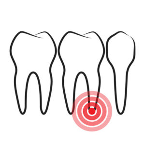 root canals Southlake