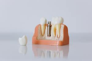 Photo by cottonbro studio: https://www.pexels.com/photo/close-up-shot-of-dental-implant-model-6502343/