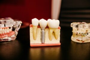 dental implants in Southlake